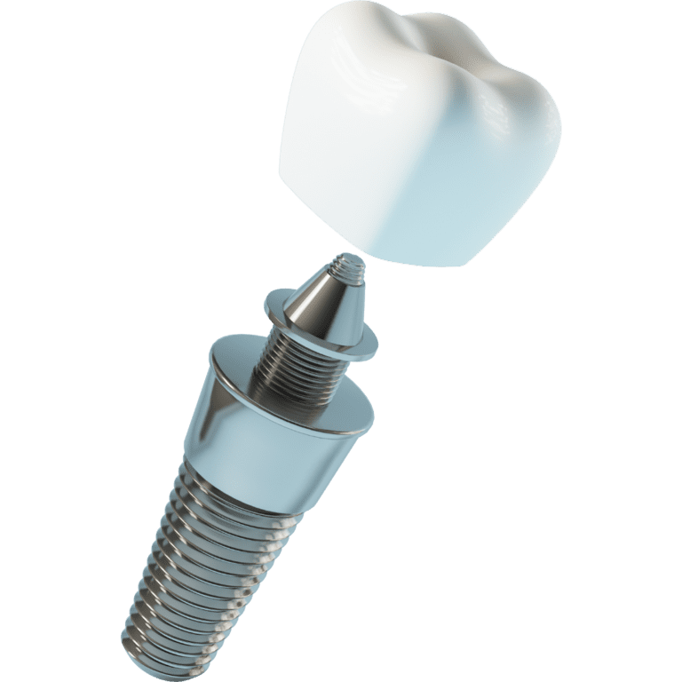 Konstrukcija dentalnog implantata u 3 dijela; implantat, zubna kruna i dentalna krunica