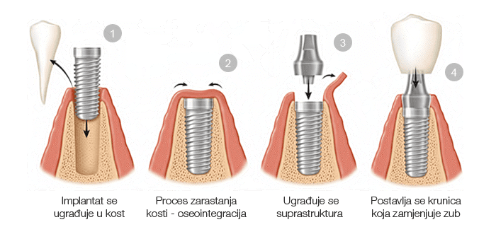 Ugradnja zubnih implantata